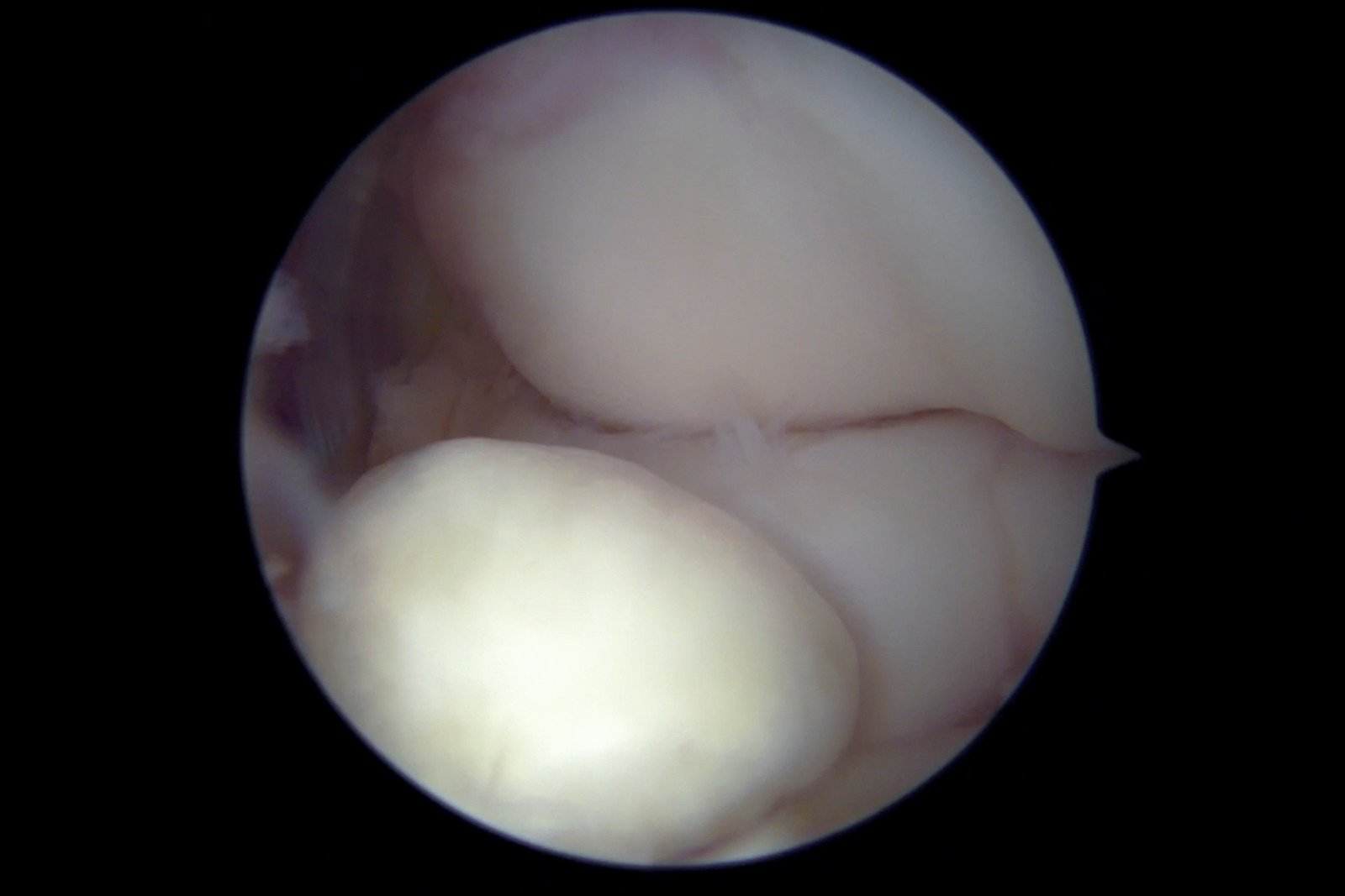 elbow loose body