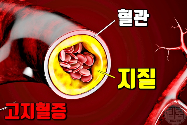 고지혈증 증상 초기증상 고지혈증원인