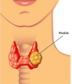 갑상선암 초기증상 갑상선암 수술비용