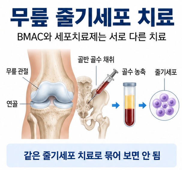 무릎 줄기세포 치료라는 제목과 무릎 관절, 자가 골수 BMAC 주사, 연골 세포치료 개념을 함께 표현한 대표 이미지