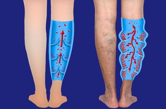 하지정맥류 원인 1위는 혈당 이상