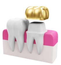 수면 임플란트 비용 과정