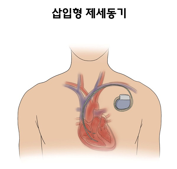 QT 연장증후군(긴QT)