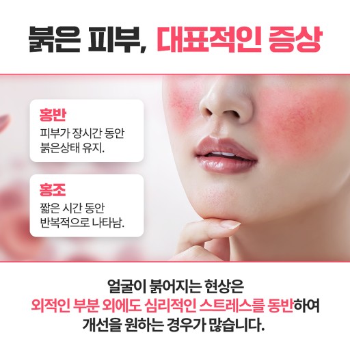 얼굴이 붉어지는 현상/ 출처 - 네이버블로그[프리모리스 인터내셔널]