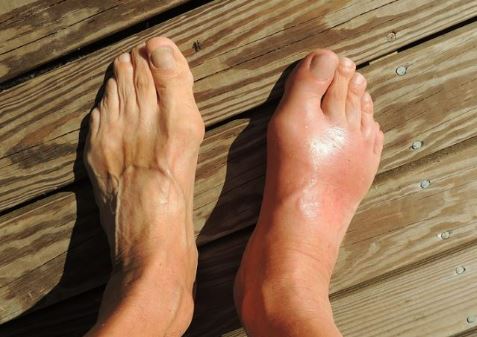 요산수치 낮추는 법 정상범위 통풍 원인