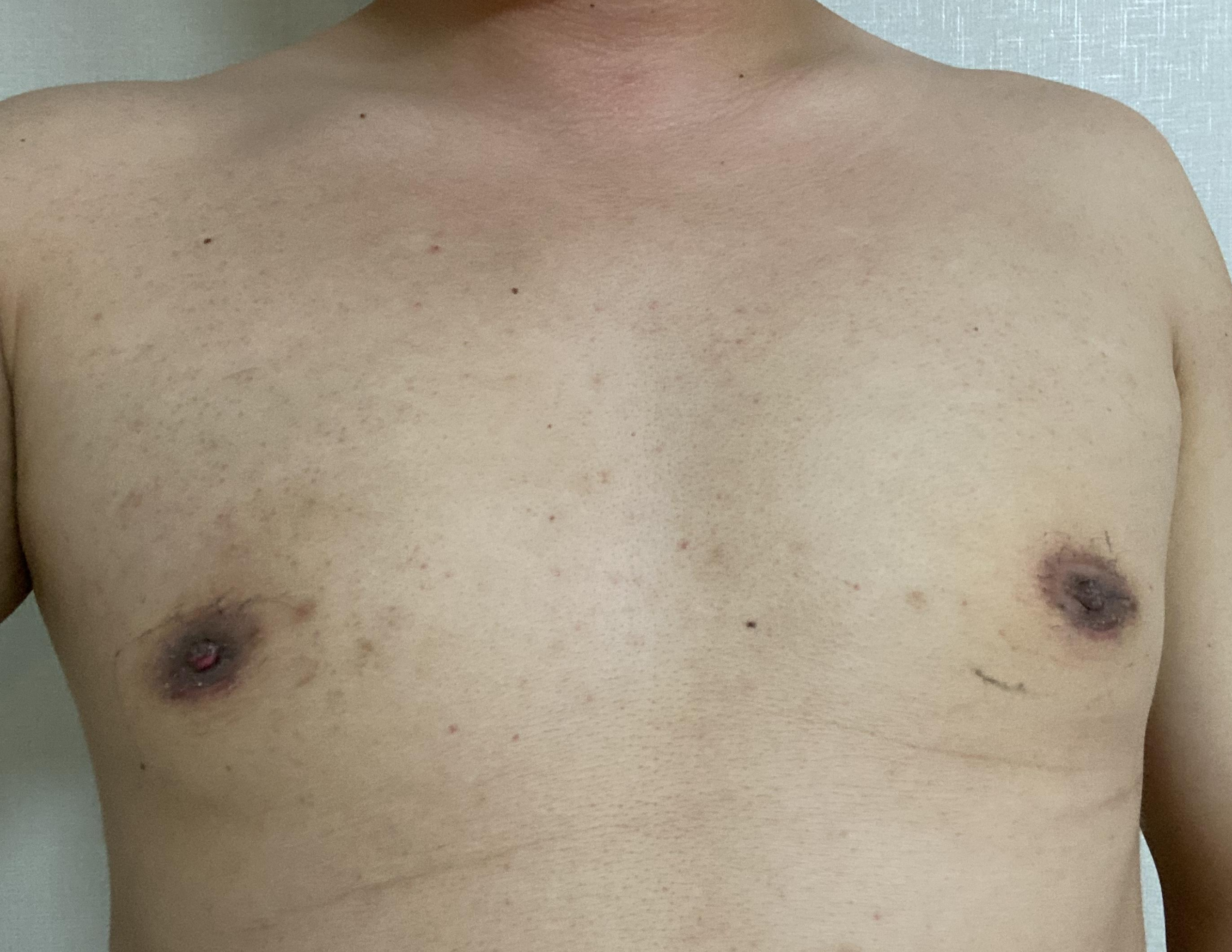 수술 2주 후 앞 모습