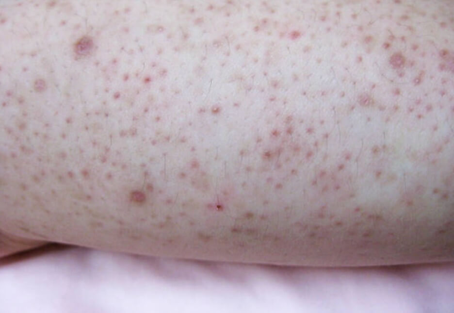 모공각화증 피부 증상