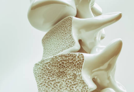 골다공증 증상&amp;#44; 수치&amp;#44; 골다공증에 좋은 음식 총정리 (2024ver)