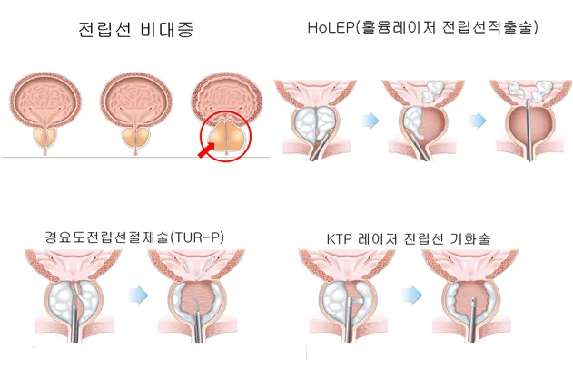 전립선비대증 치료