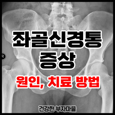 좌골신경통 증상
