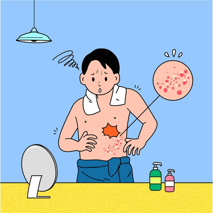 대상포진이 발생하였을 때의 상황 설명