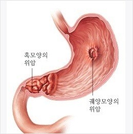 위암