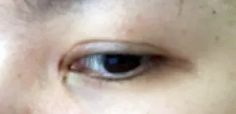 눈물샘 뚫는 수술 간단한가요에 대한 수술정보_16