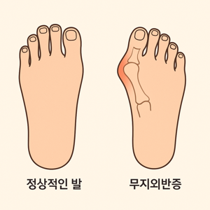 정상적인발과 무지외반증발 비교