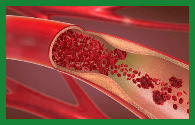 심혈관질환예방