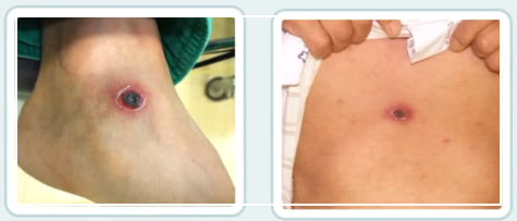 쯔쯔가무시 초기증상 치료방법 