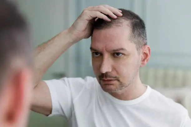 탈모 종류 완벽 가이드