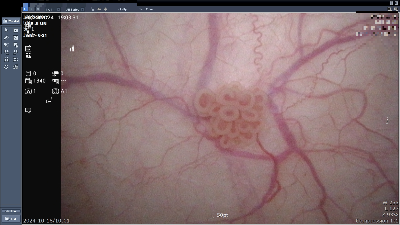 방광암 0기 내시경 사진