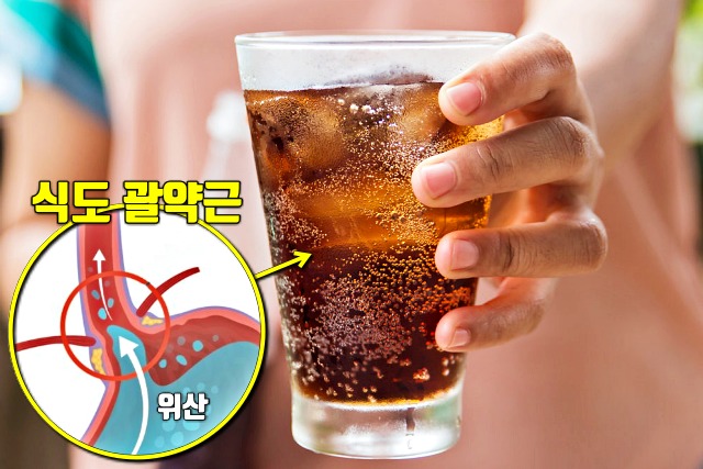 속쓰림 증상 원인 음식, 탄산음료, 식도염, 위식도역류, 건강, 매일꿀정보