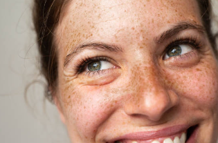 주근깨 없애는 방법
