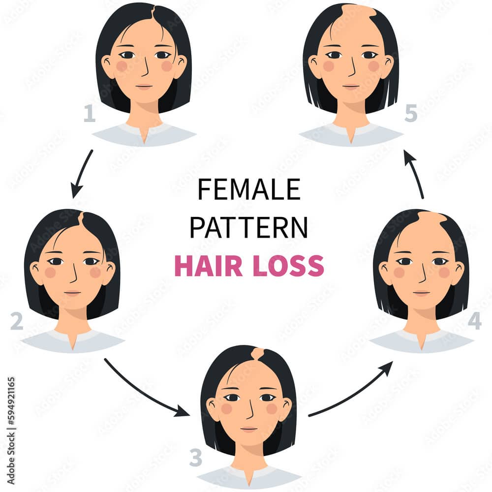 여성 탈모 패턴