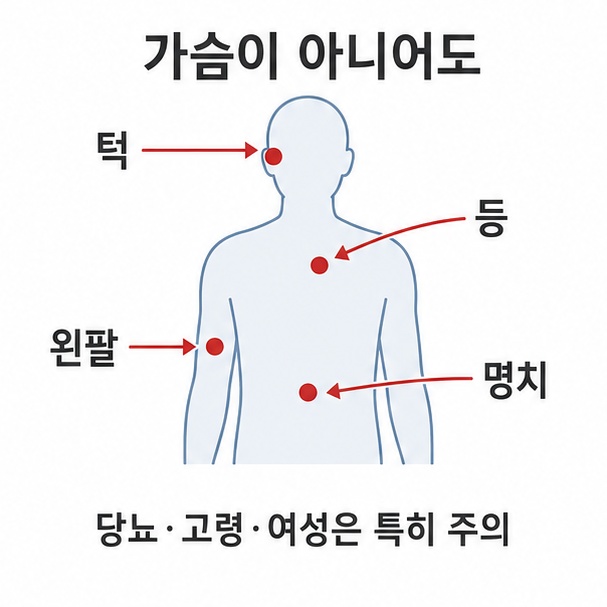가슴이 아니어도 나타나는 통증 부위, 턱과 등, 왼팔, 명치를 화살표로 표시한 상반신 도해