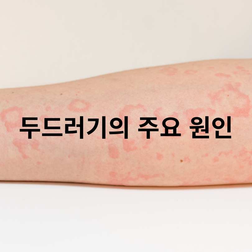 두드러기 간지러움 심할 때 해결방법과 원인