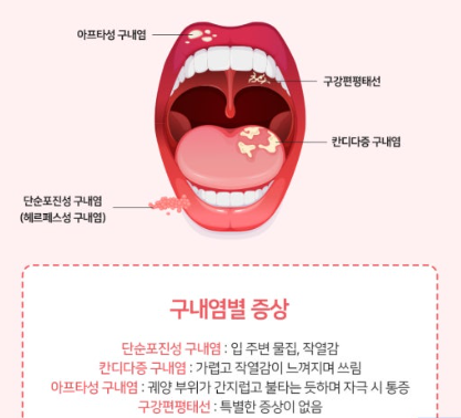 구내염과 구강암 관련 사진