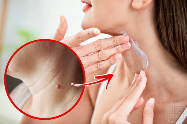 목 사마귀 제거 연고