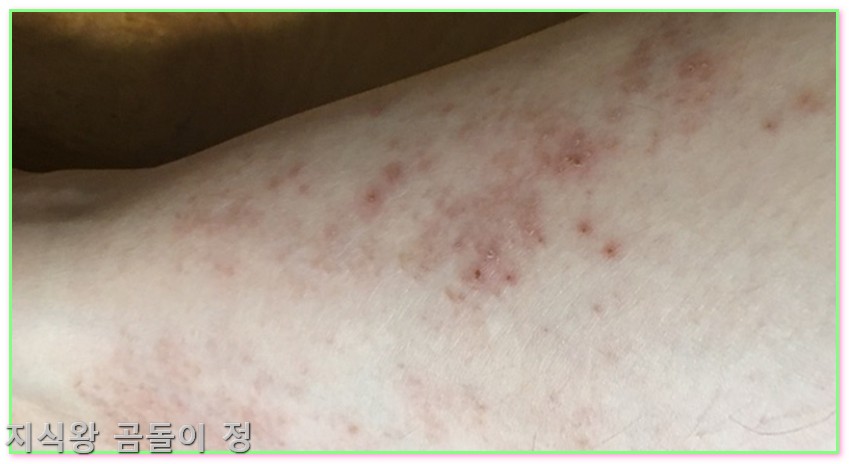 온몸 간지러움 전신 가려움증 두드러기 피부장벽 관리와 보습 루틴 꿀팁2