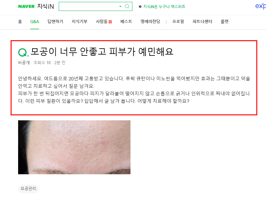 모공이 너무 안좋아 고민인 지식인