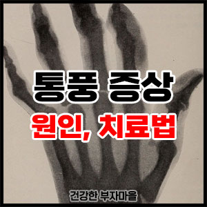 통풍 증상