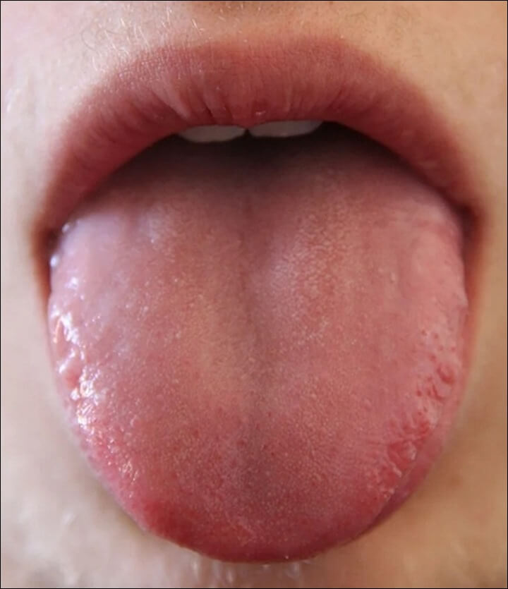 혓바늘 없애는 방법 휴식