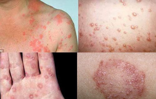 대상포진 예방접종 가격 (+ 최저가&amp;#44; 무료접종)