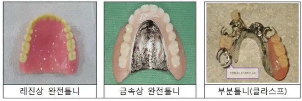 레진상-완전틀니와-금속상-완전틀니