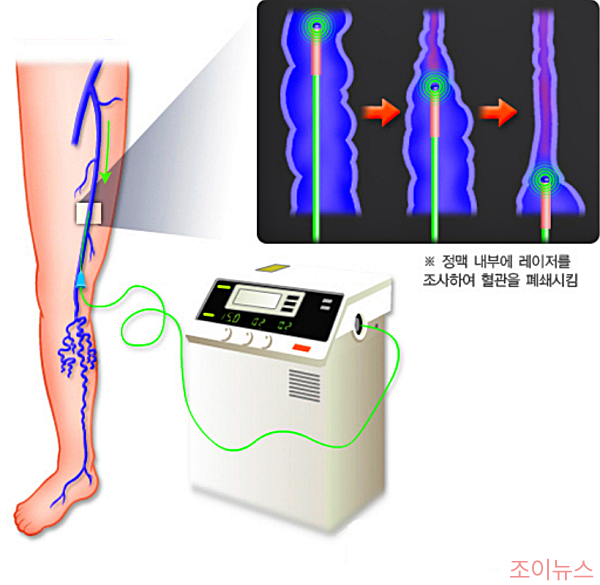 하지정맥류 치료법 중 정맥내 열치료, 고주파 레이저 치료법