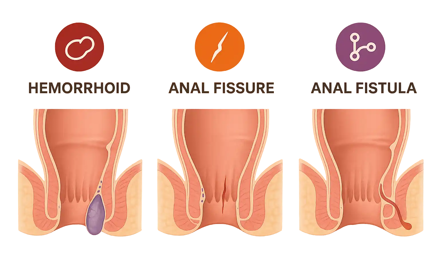 치핵·치열·치루 3가지 항문 질환을 나란히 비교