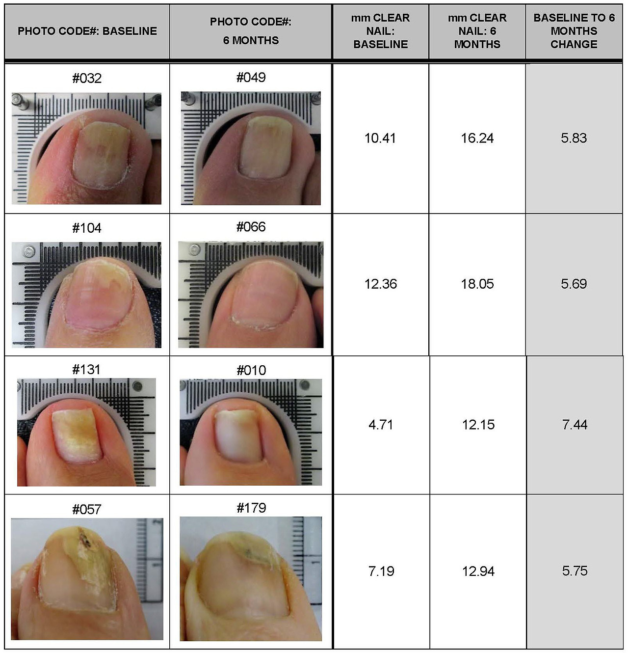 발톱무좀-레이저-치료-루눌라레이저