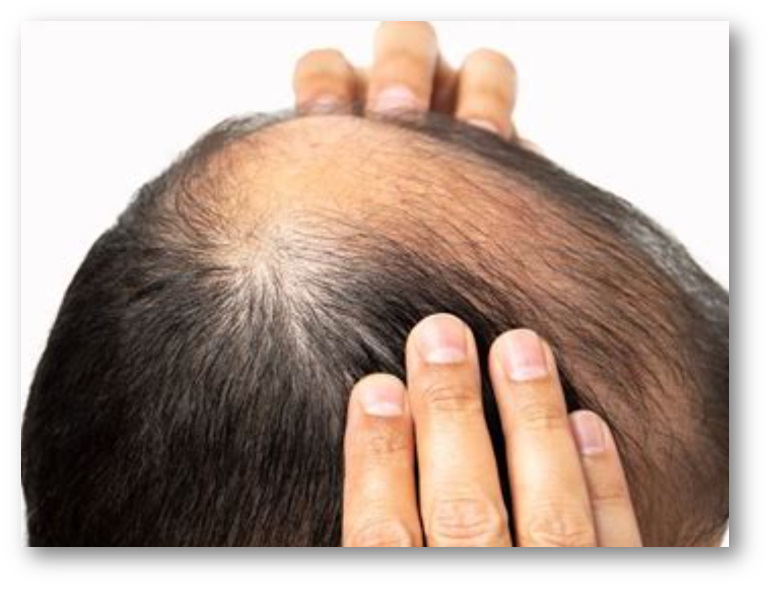 미녹시딜과 로게인폼4