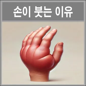 손등 붓는 이유 혈액순환 문제 증상과 해결법 정리_25