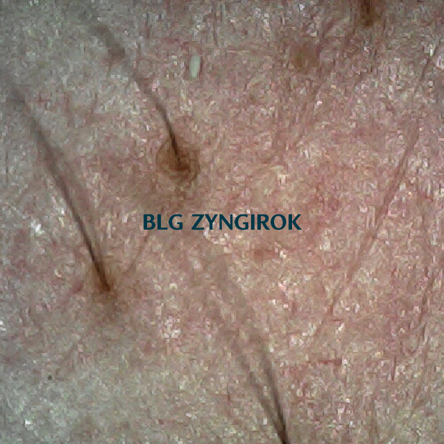 오른쪽 M자 부위 두피사진 모습이다.