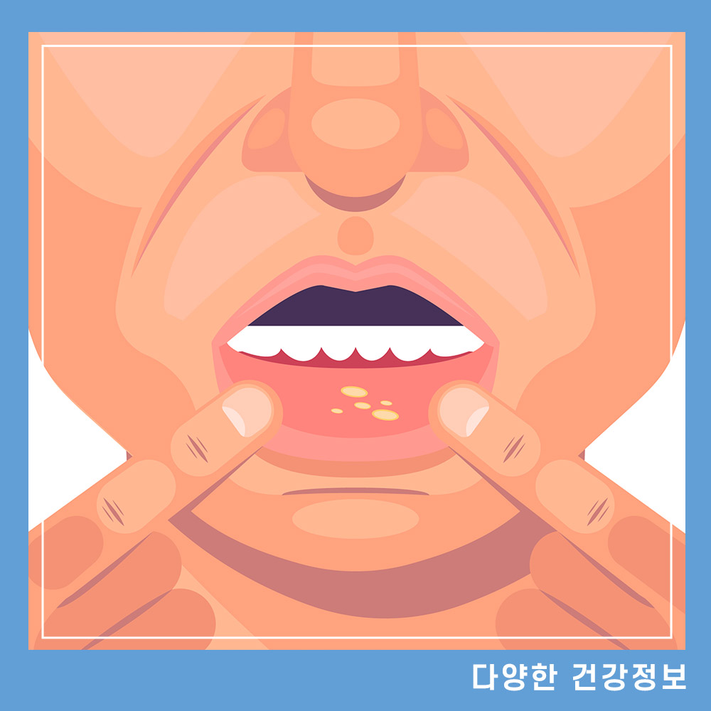 구내염 원인 증상 치료 방법