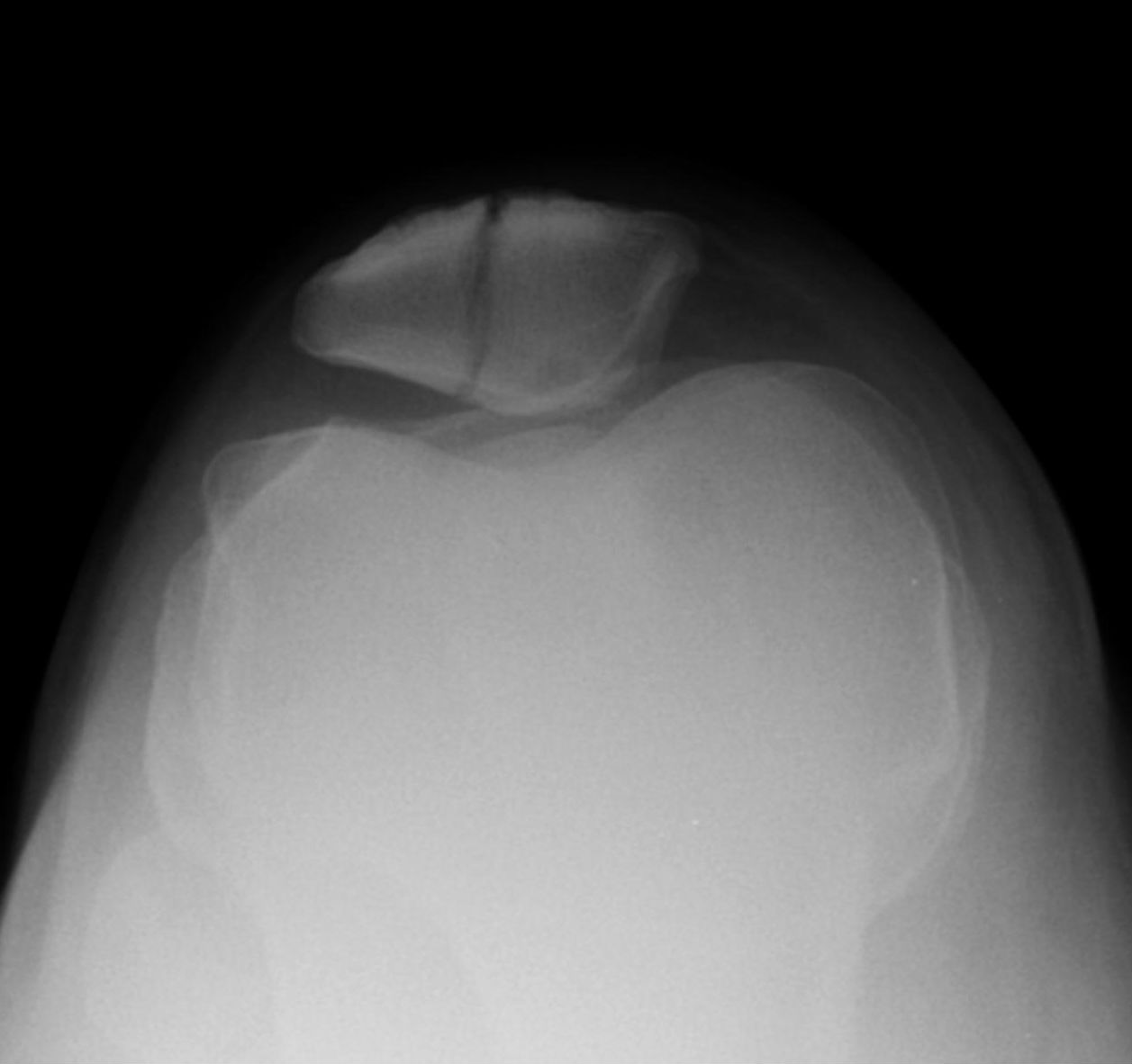 슬개골의 종골절