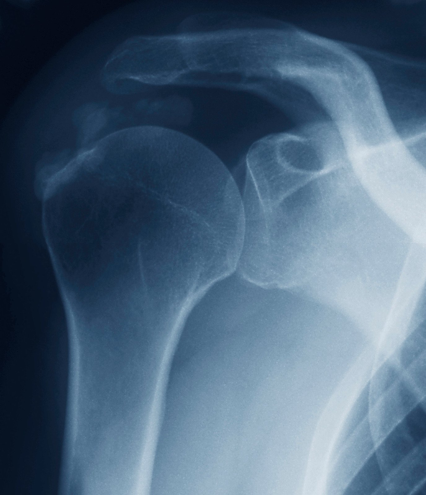 석회화 건염 (Calcific Tendonitis): 원인, 증상 및 치료