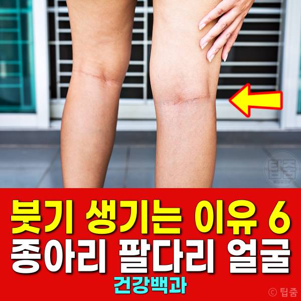 붓기 생기는 이유 종아리붓기 팔다리붓기 손발붓기 얼굴붓기