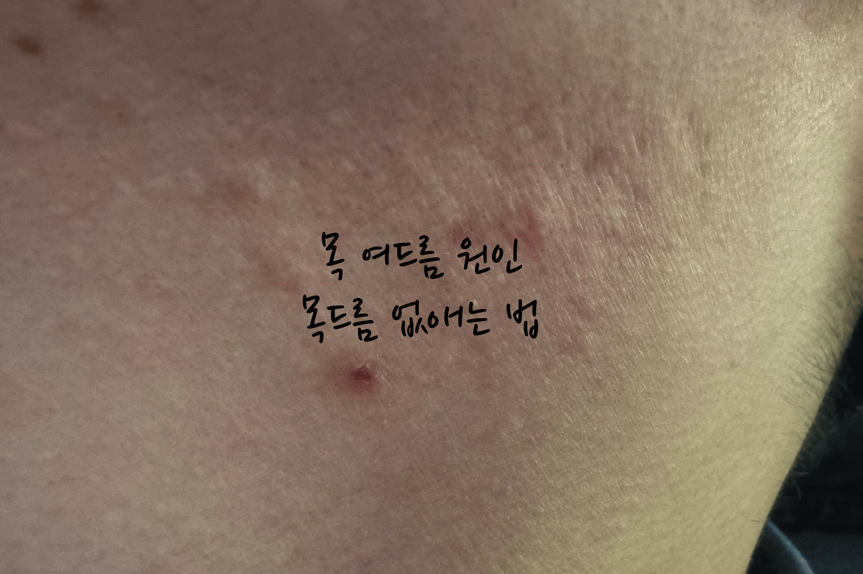 목 여드름 원인