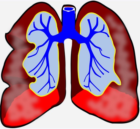 폐결핵원인
면연력과폐결핵