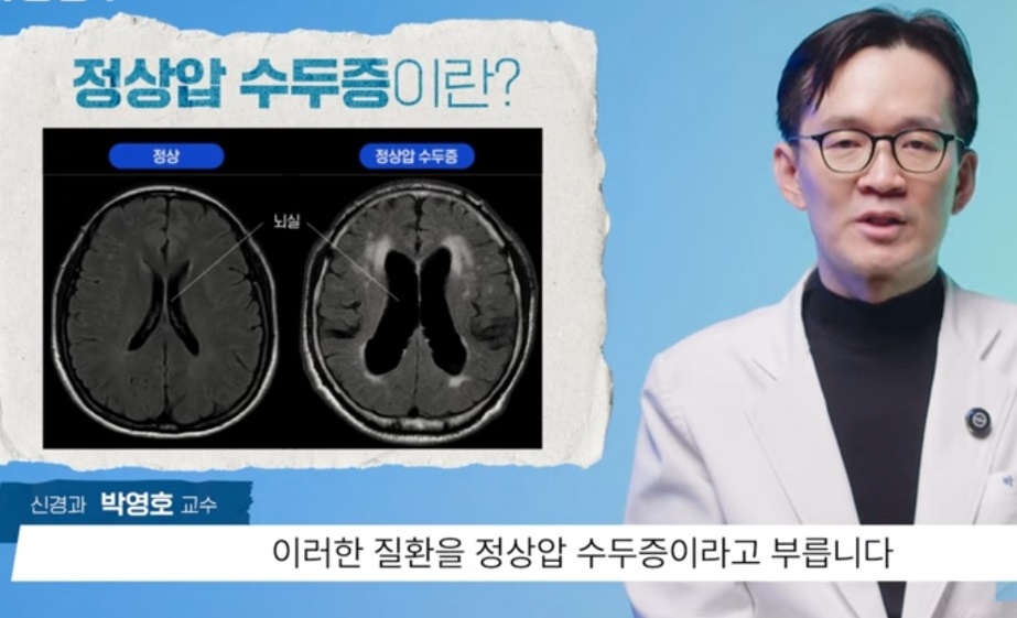 정상압수두증