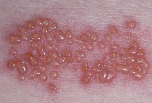 대상포진 물집 증상