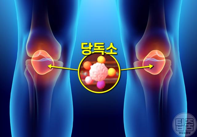 관절염에 나쁜 음식,관절염에 안 좋은 음식,당독소,팁줌